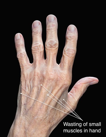 cubital-tunnel-syndrome