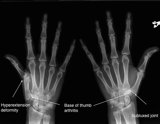 base-of-thumb-arthritis