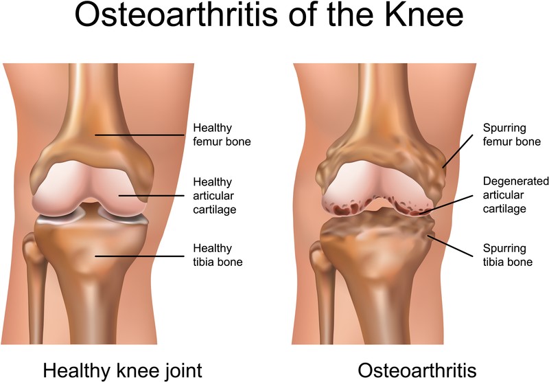 Knee Replacement Oxford Orthopaedics