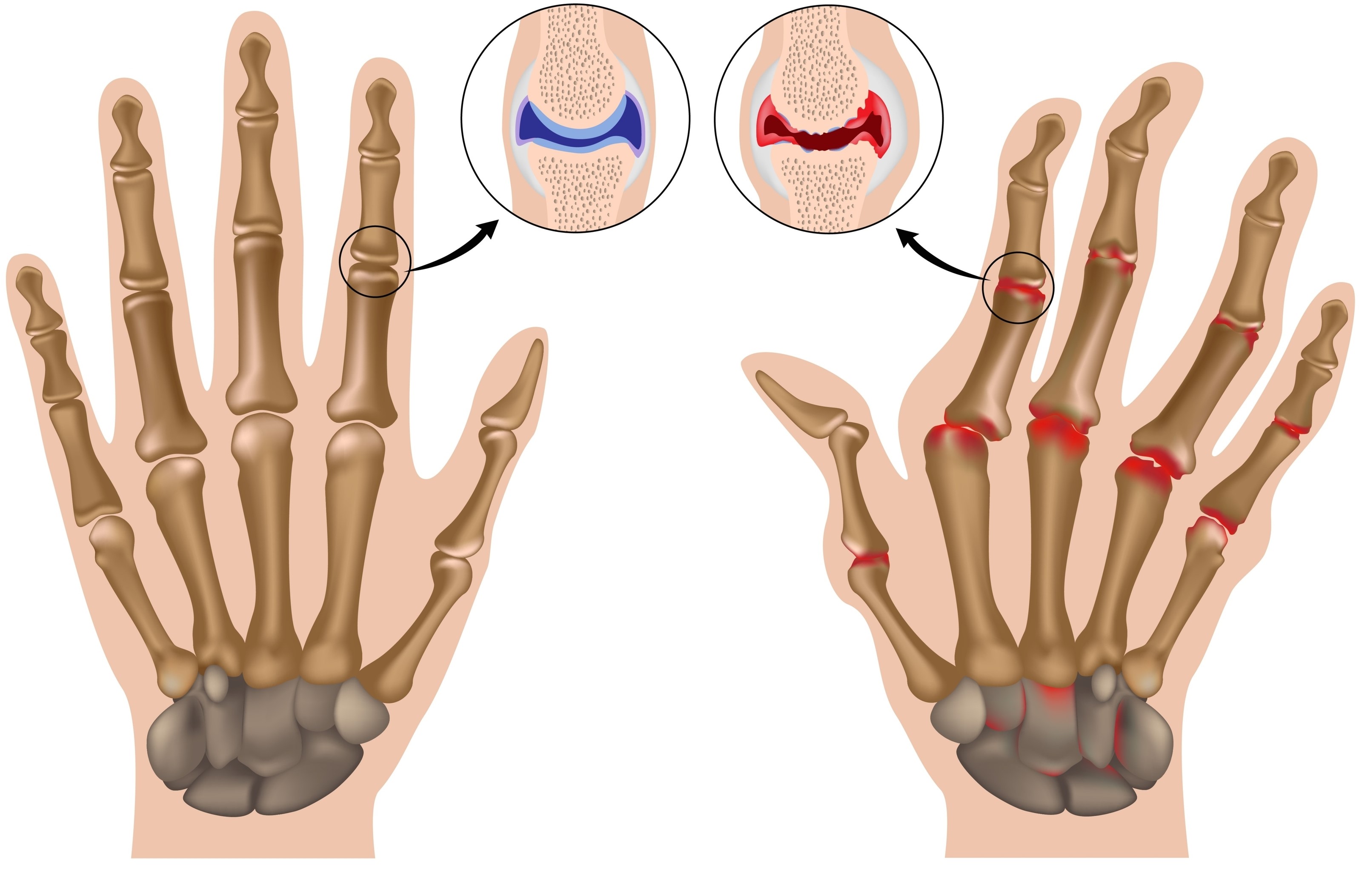 early osteoarthritis hands