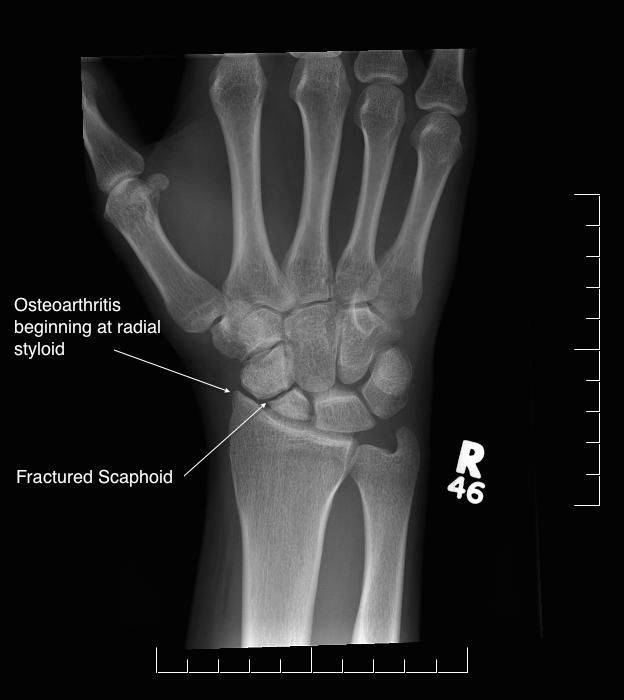 Hands Arthritis Oxford Orthopaedics