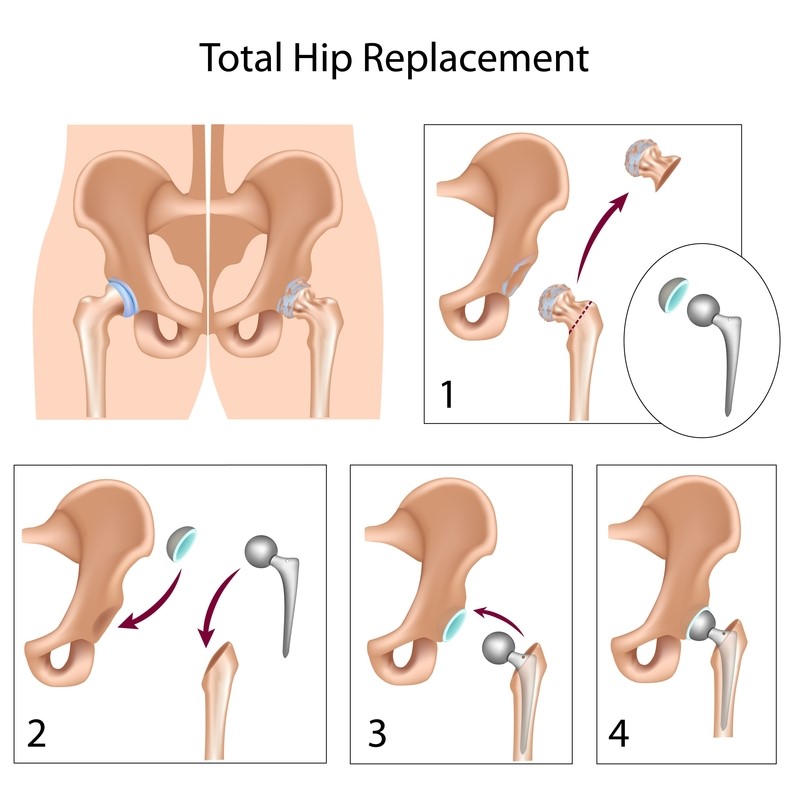 Total Joint Replacement - OrthoInfo - AAOS