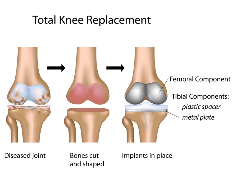 knee-replacement-oxford-orthopaedics