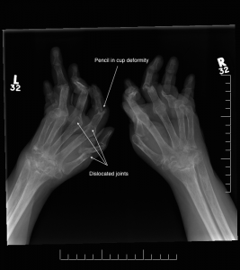 Hands – Arthritis « Oxford Orthopaedics