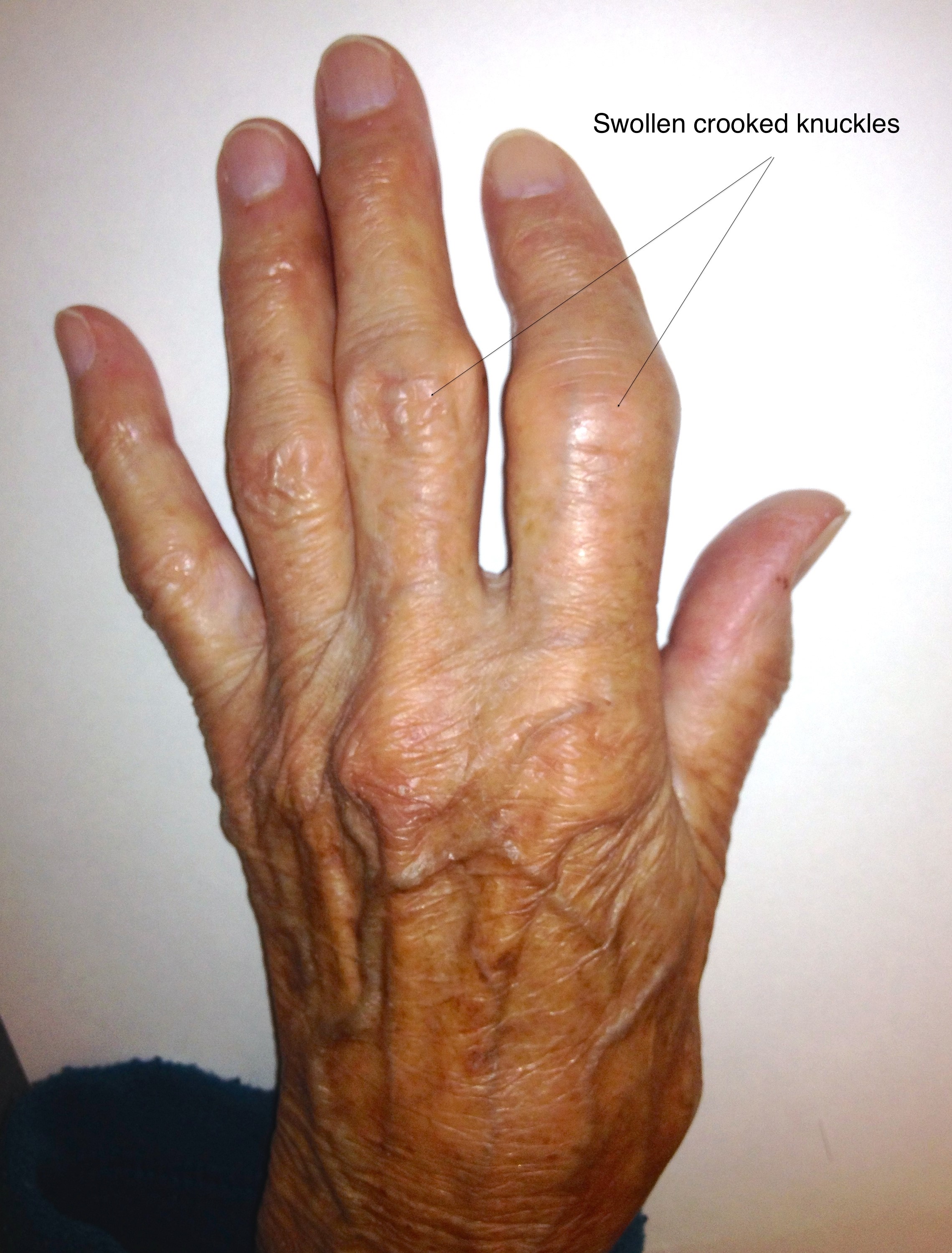 Arthritic Hands And Fingers Hand Exercises With Medications GZBWK