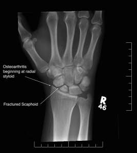 Hands – Arthritis « Oxford Orthopaedics